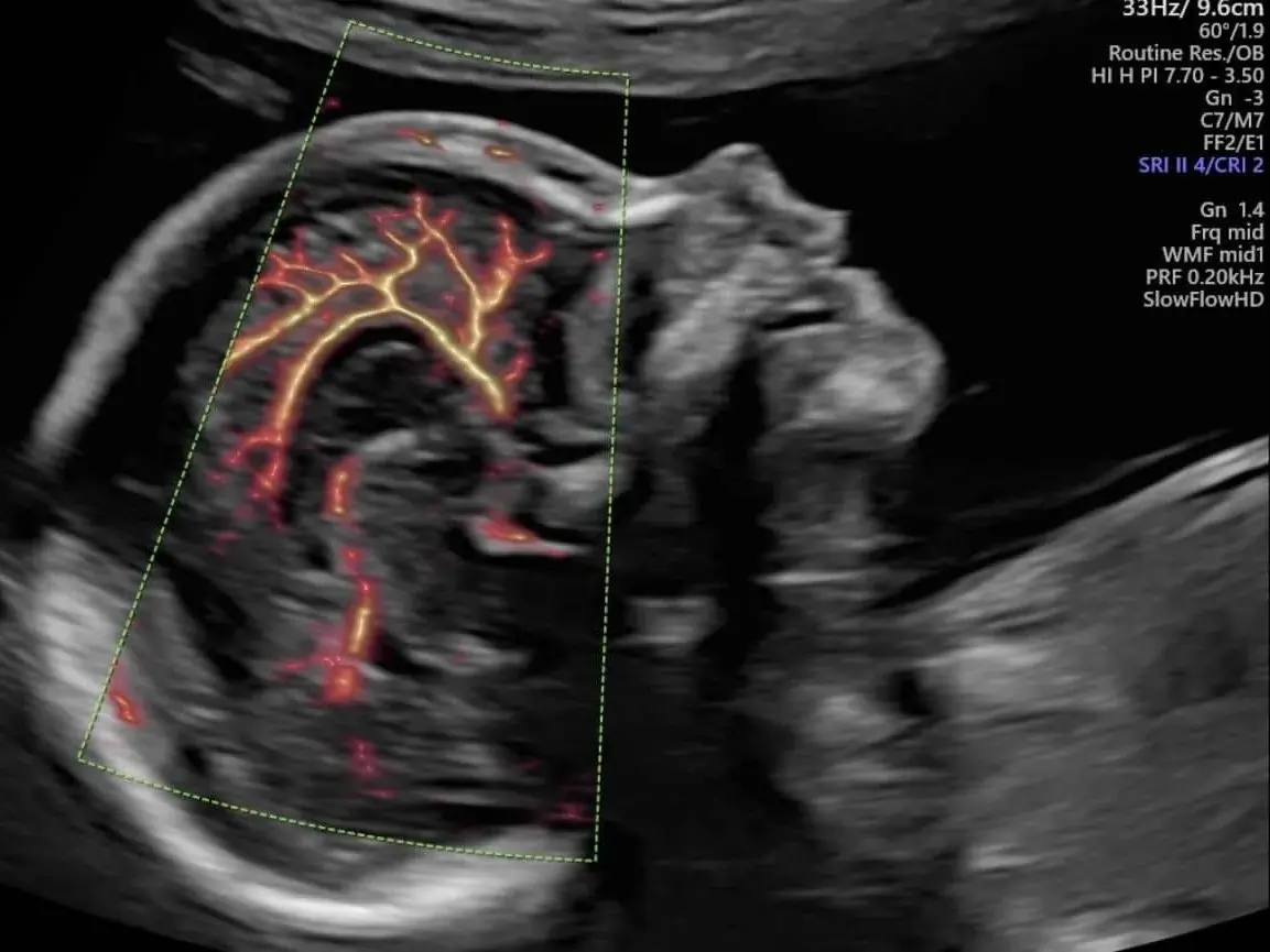 Ultrassom Obstétrico Morfológico